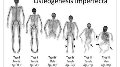 Osteogenesis Imperfecta (Brittle Bone Disease)