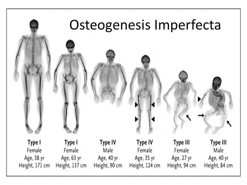 Osteogenesis Imperfecta (Brittle Bone Disease)