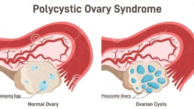 PCOS (Polycystic Ovary Syndrome)