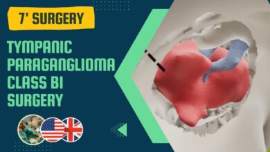 Paraganglioma
