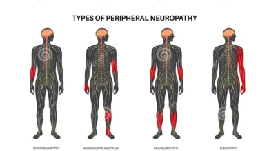 Peripheral Neuropathy