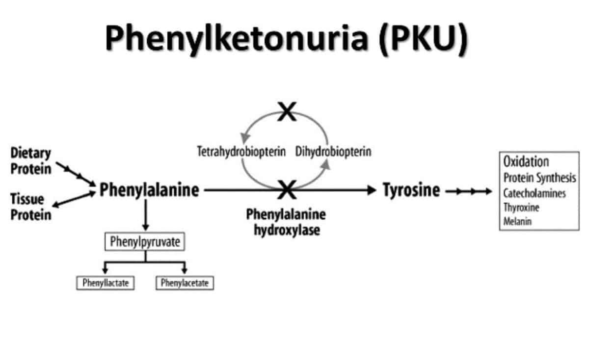 Phenylketonuria (PKU)