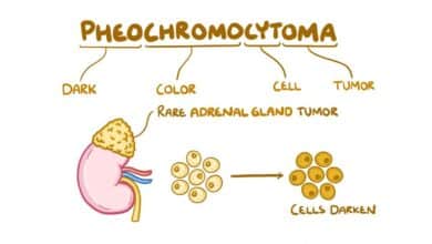 Pheochromocytoma