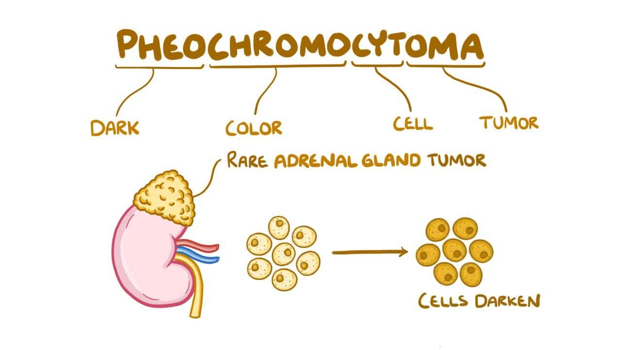 Pheochromocytoma