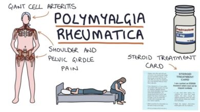 Polymyalgia Rheumatica