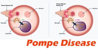 Pompe Disease
