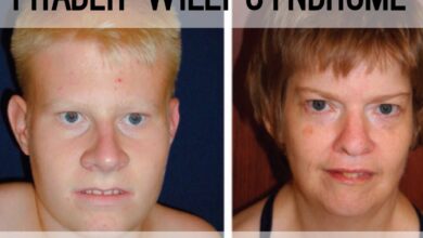 Prader-Willi Syndrome