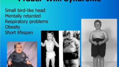 Prader-Willi Syndrome