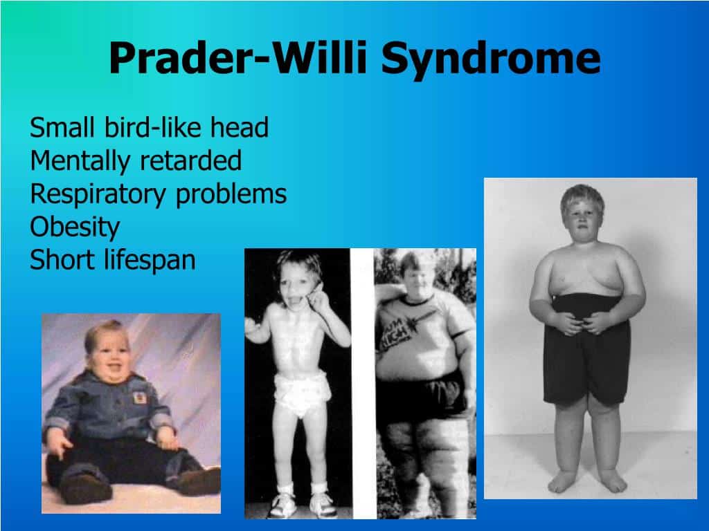 Prader-Willi Syndrome