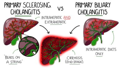Primary Biliary Cholangitis (PBC)