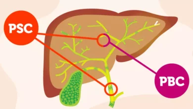 Primary Biliary Cholangitis (PBC)