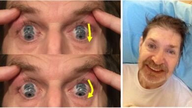 Progressive Supranuclear Palsy (PSP)