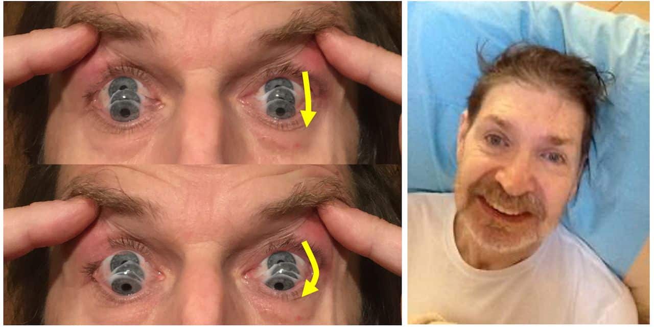 Progressive Supranuclear Palsy (PSP)