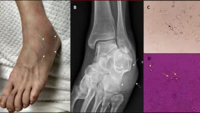 Pseudogout (CPPD Disease)