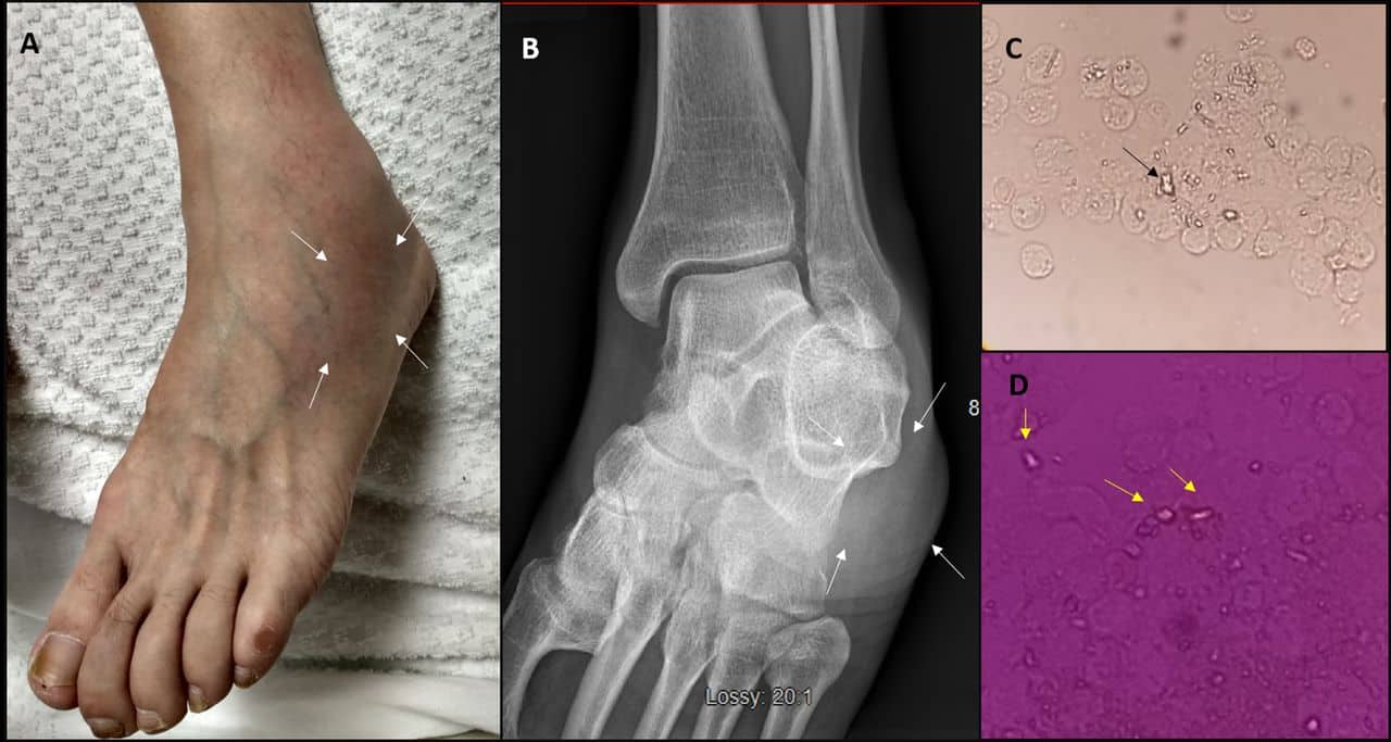 Pseudogout (CPPD Disease)
