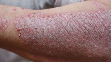 Psoriasis