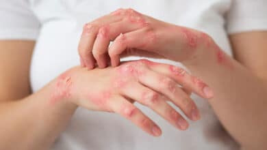Psoriasis