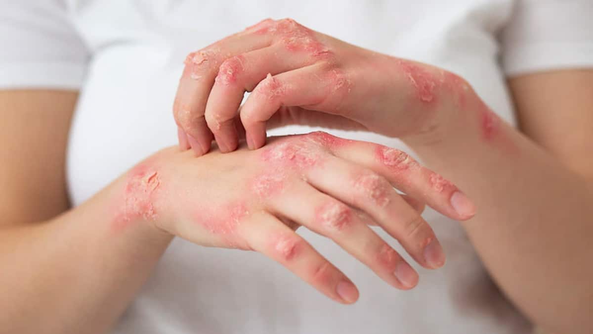 Psoriasis