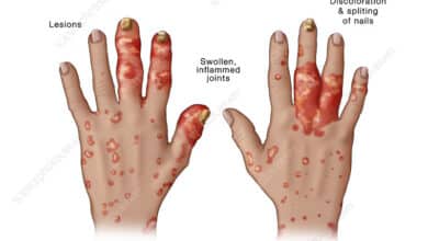 Psoriatic Arthritis