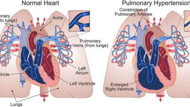 Pulmonary Arterial Hypertension