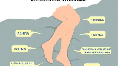 Restless Legs Syndrome