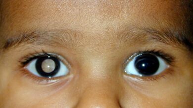 The Eye Cancer That Primarily Affects Young Children