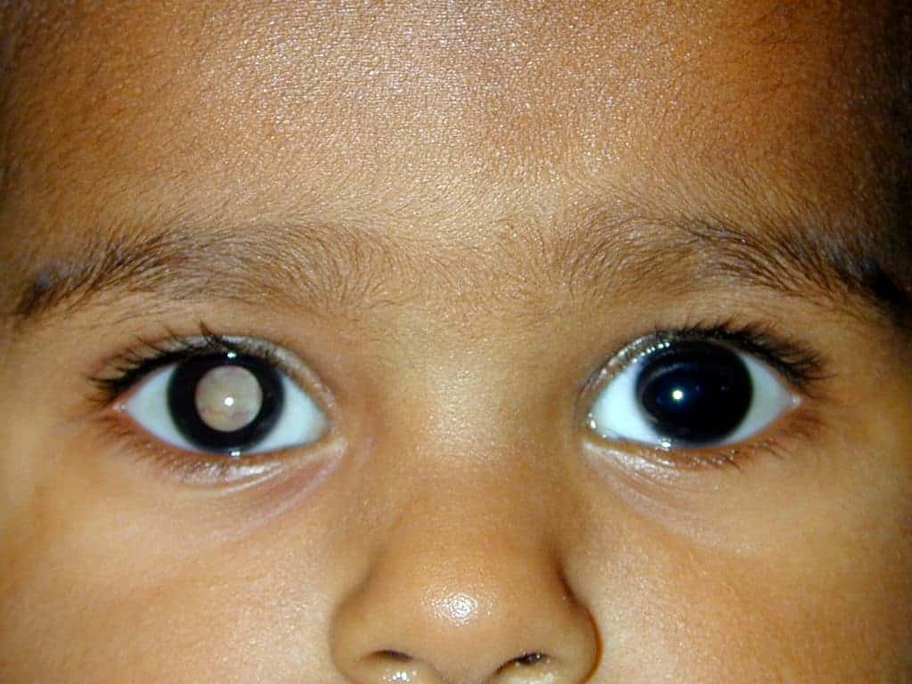 The Eye Cancer That Primarily Affects Young Children