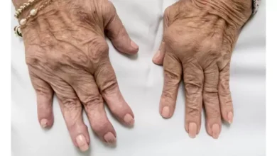 Rheumatoid Arthritis