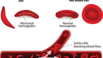 Sickle Cell Disease