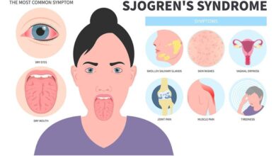 Sjögren's Syndrome