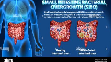 Small Intestinal Bacterial Overgrowth (SIBO)