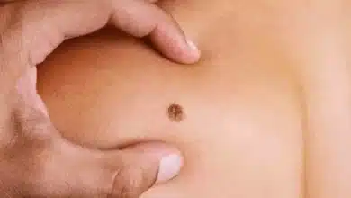 Soft Tissue Sarcoma