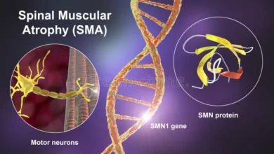 Spinal Muscular Atrophy (SMA)