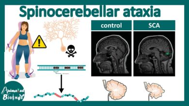 Spinocerebellar Ataxia