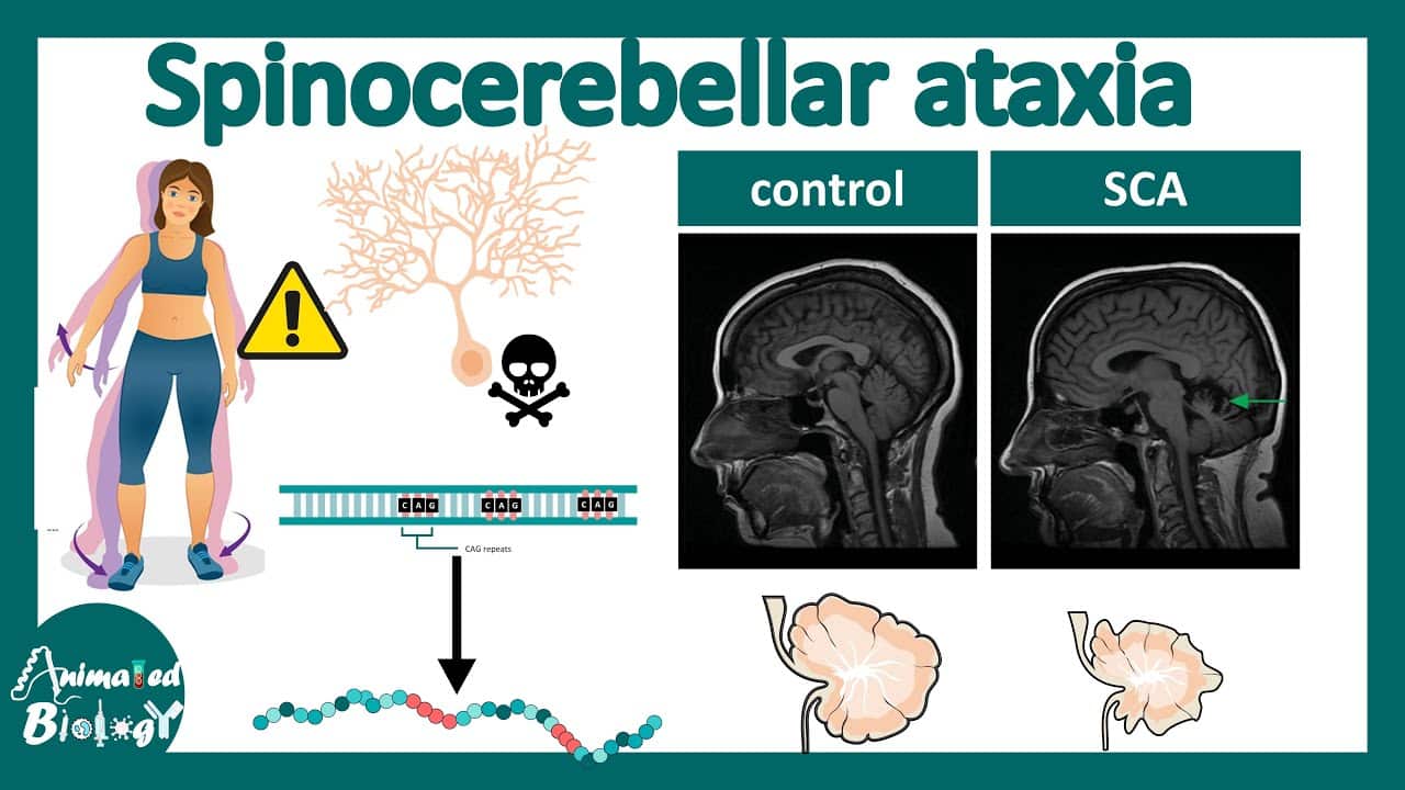 Spinocerebellar Ataxia
