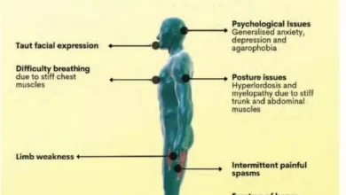 Stiff Person Syndrome