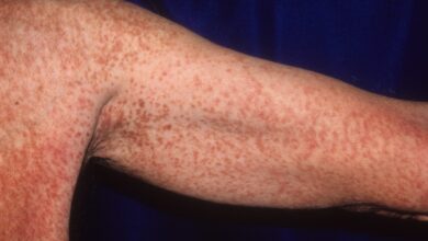 Systemic Mastocytosis