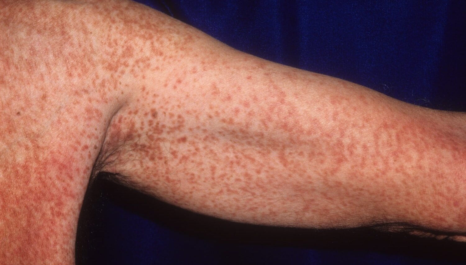 Systemic Mastocytosis