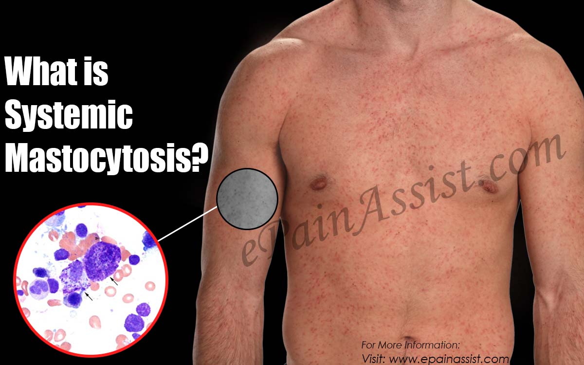 Systemic Mastocytosis