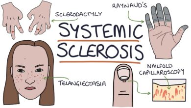 Systemic Sclerosis