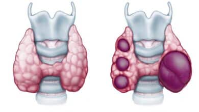 Thyroid Nodules