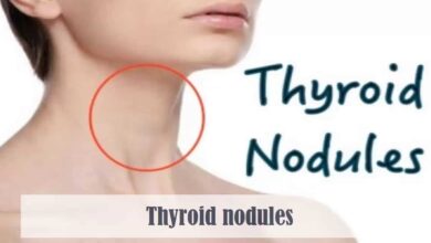 Thyroid Nodules