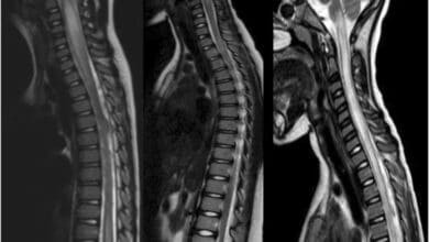 Transverse Myelitis