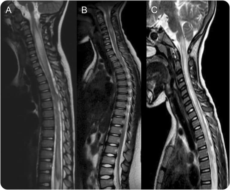 Transverse Myelitis