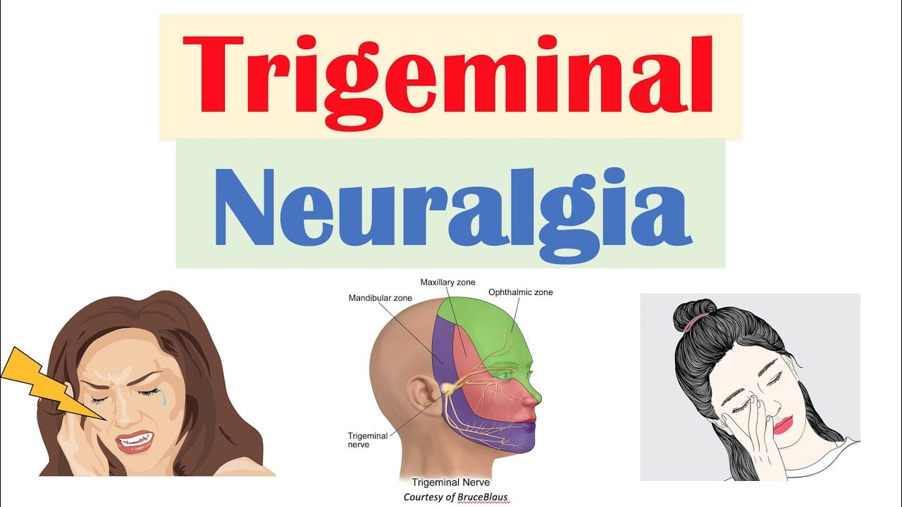Trigeminal Neuralgia