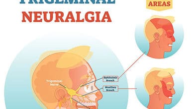 Trigeminal Neuralgia