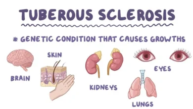 Tuberous Sclerosis Complex