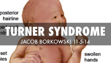Turner Syndrome