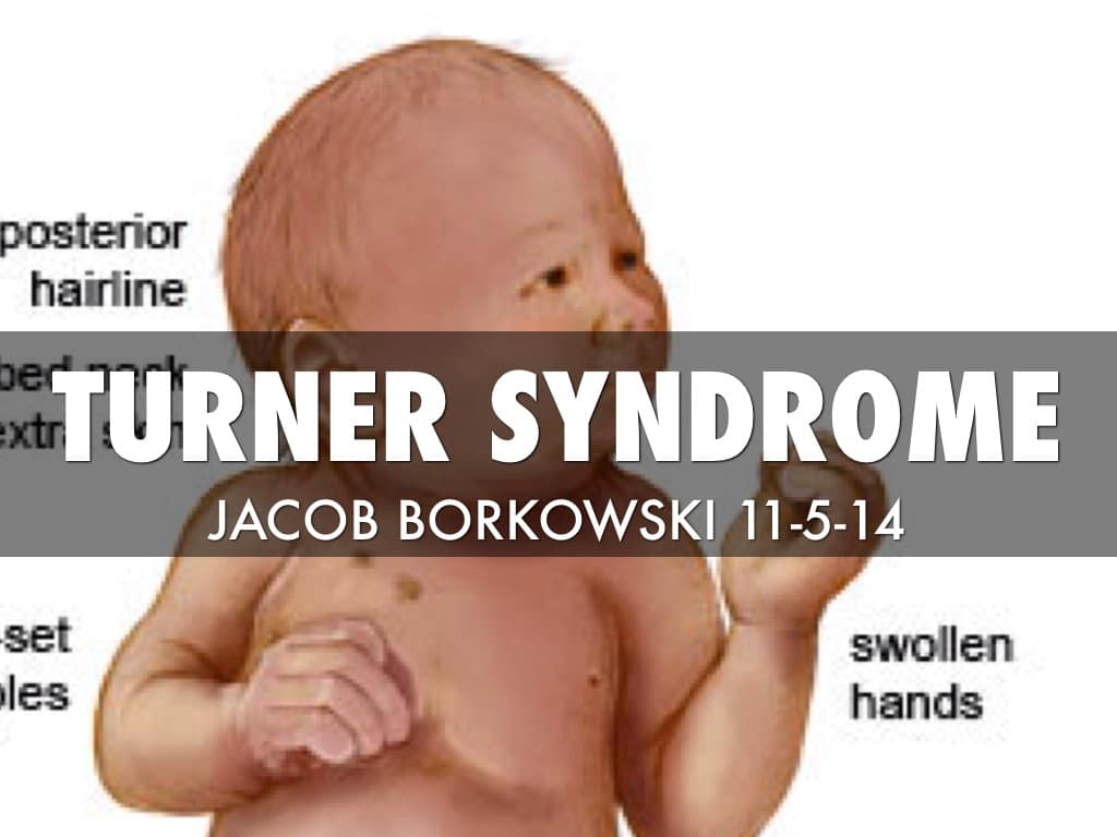 Turner Syndrome