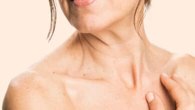 Turner Syndrome